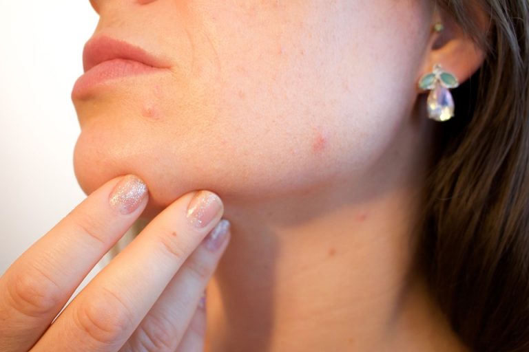 acne a 40 anni