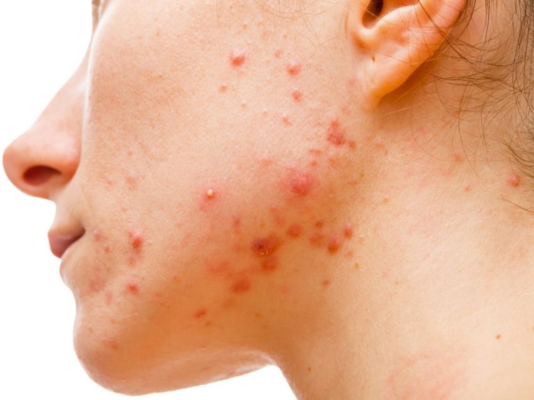Acne: come riconoscerla