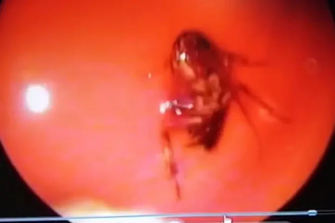 India: scarafaggio nel cranio di una donna