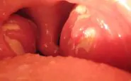tonsille gonfie per la scarlattina