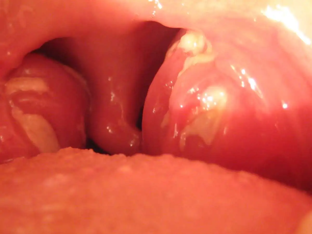 tonsille gonfie per la scarlattina