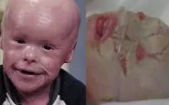 Un bambino con una malattia della pelle incredibile: la sua storia