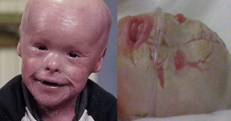 Un bambino con una malattia della pelle incredibile: la sua storia