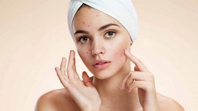 ACNE SUL VISO.