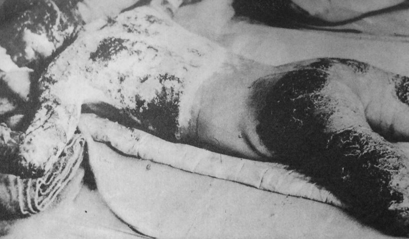 Victim_of_Hiroshima_atomic_bombing_1