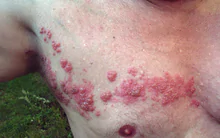 220px-Herpes_zoster_chest