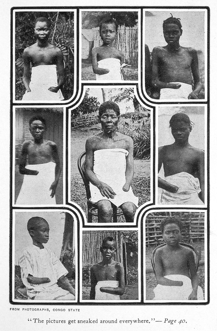 MutilatedChildrenFromCongo