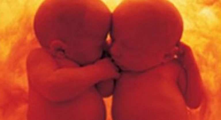 Napoli, salvati gemelli nel grembo di madre affetta da tumore Napoli