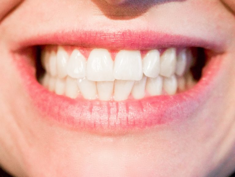SBIANCAMENTO DENTI.