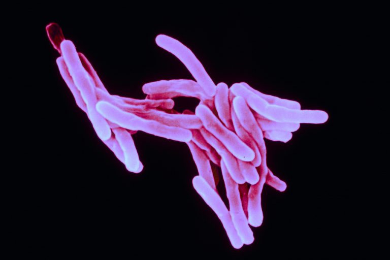 tubercolosi