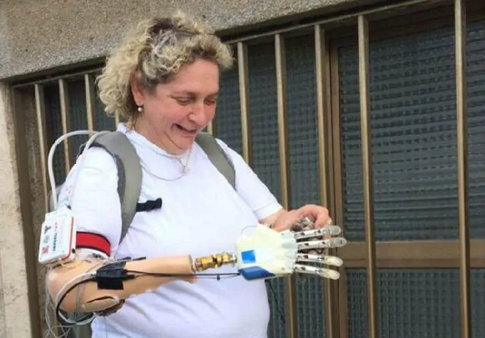 Mano bionica impiantata