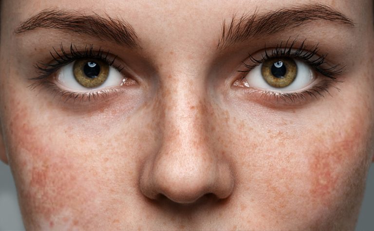 Melasma e Cloasma gravidico: cause, sintomi e cure migliori melasma
