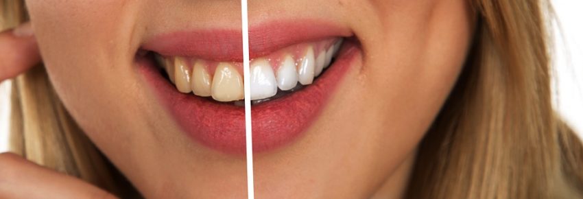 sbiancare i denti
