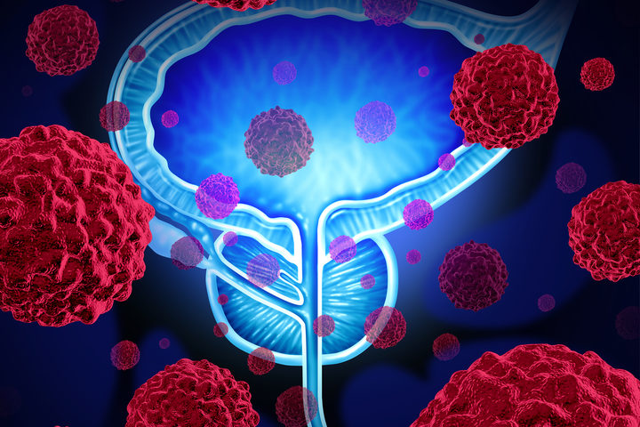 Come abbassare il Psa nel sangue: rimedio efficace Psa