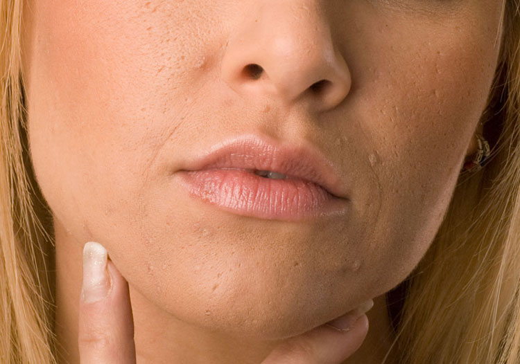 quale crema per cicatrici utilizzare crema per cicatrici