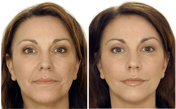 lifting viso: come funziona e quanto costa lifting viso