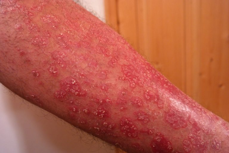 Cos'è la psoriasi guttata: cause, sintomi e rimedi. psoriasi guttata