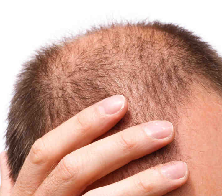 caduta capelli