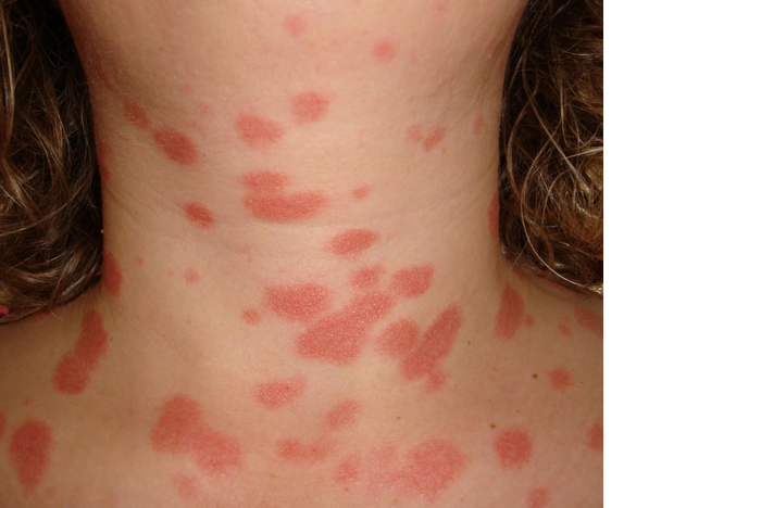 cura psoriasi