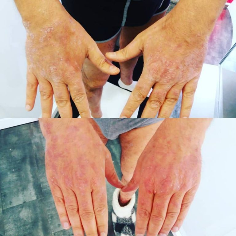 psoriasi psoriasi