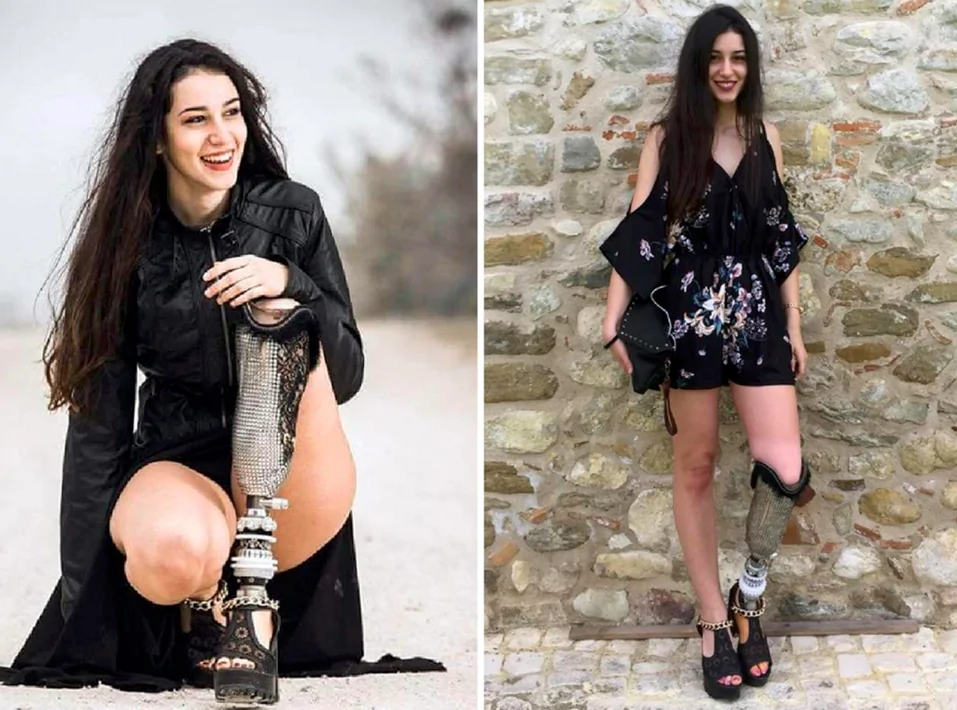 Miss Italia con la protesi