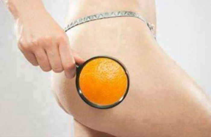 cellulite