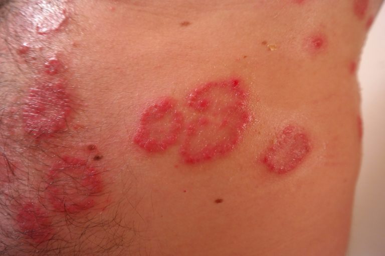 Psoriasi, le cause, i sintomi, le cure