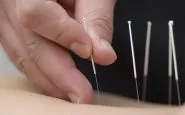 agopuntura