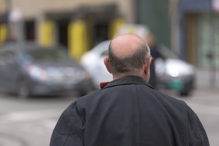 Calvizie maschile: come correre subito ai ripari