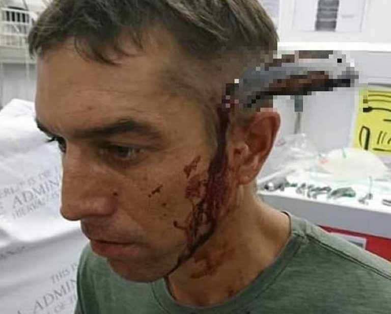 Ciclista arriva in ospedale con un coltello in teste: "c'è un dottore?"