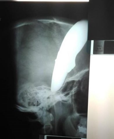 Ciclista arriva in ospedale con un coltello in teste: "c'è un dottore?"