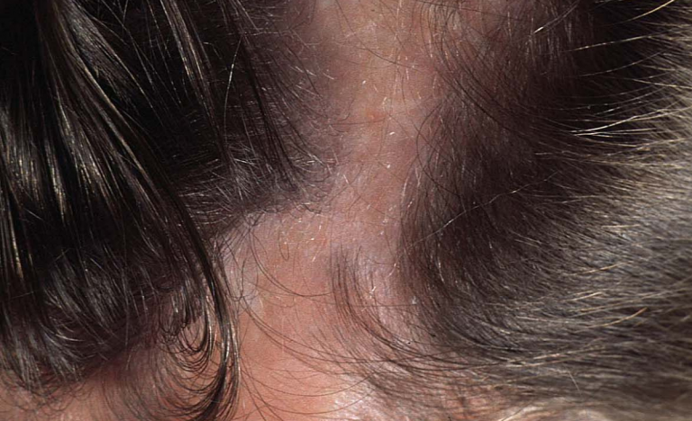 Alopecia femminile rimedi naturali