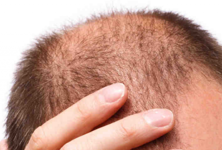 caduta capelli