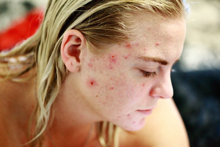 Acne.