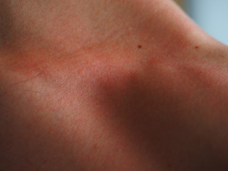 Disidrosi: le cause e la migliore cura naturale