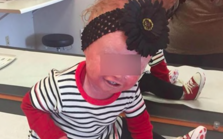 Anna, la bimba con la malattia che le fa staccare la pelle