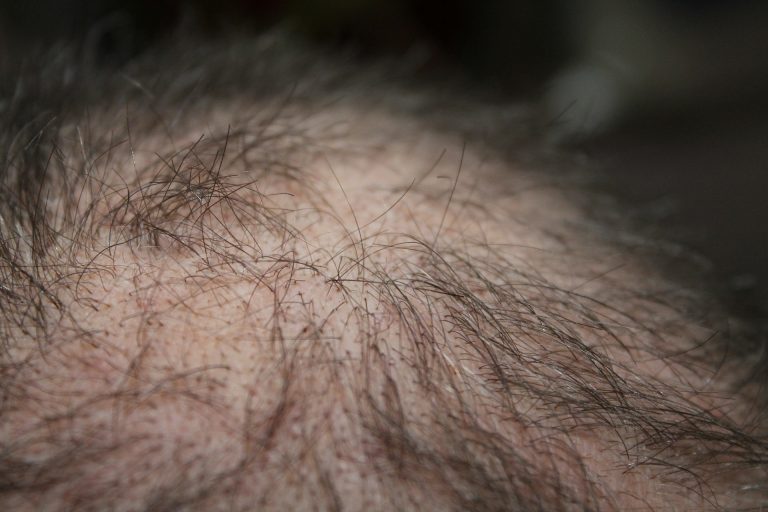 Caduta capelli: sintomi e cure naturali