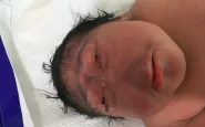 bambino-nato-senza-naso