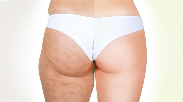 come combattere la cellulite