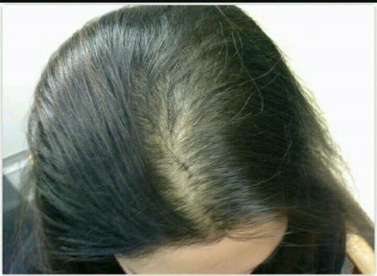 diradamento capelli