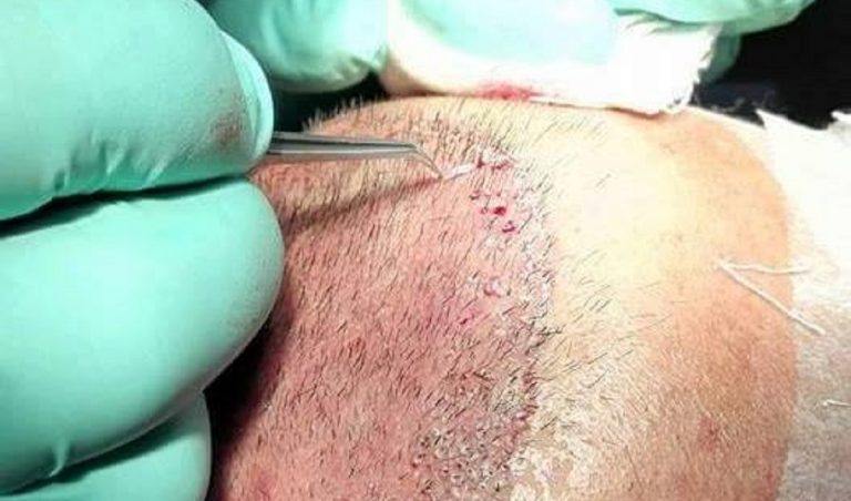 trapianto capelli