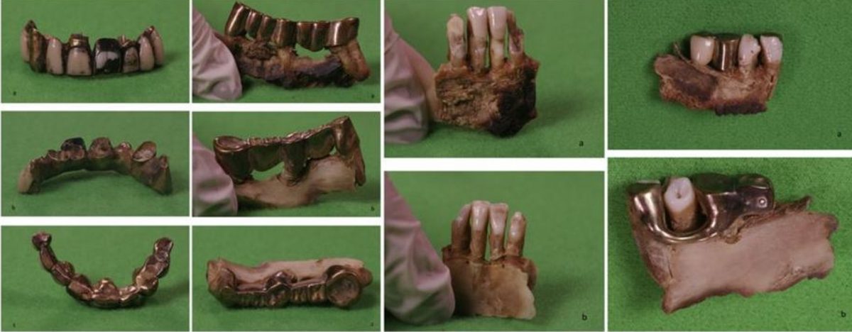hitler denti morto