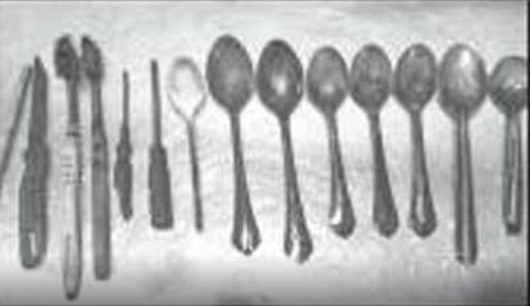 medici trovano posate in intestino umano