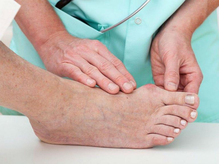 plantare alluce valgo