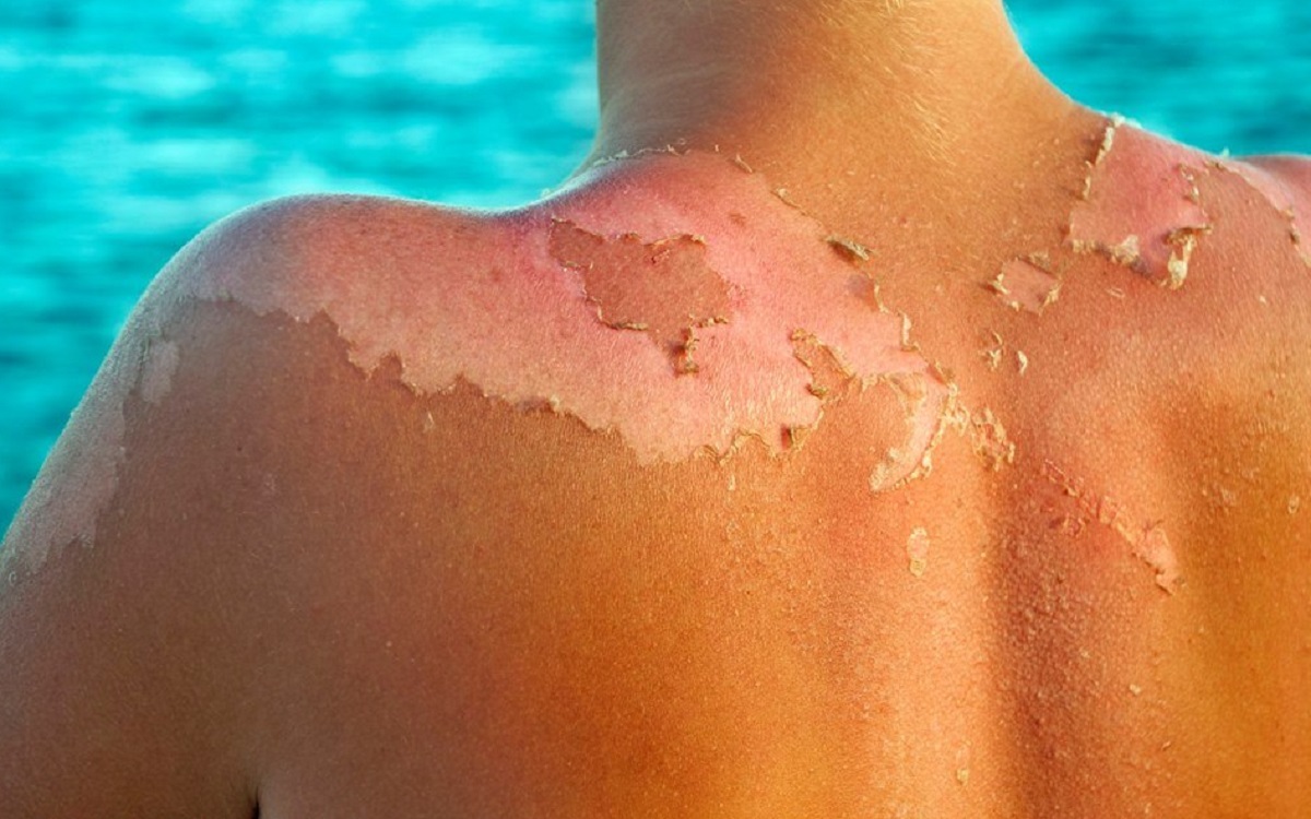 Scottatura solare, in quanto passa e come prevenirla