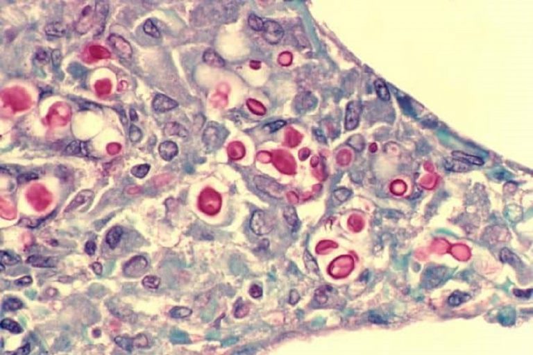 candida auris