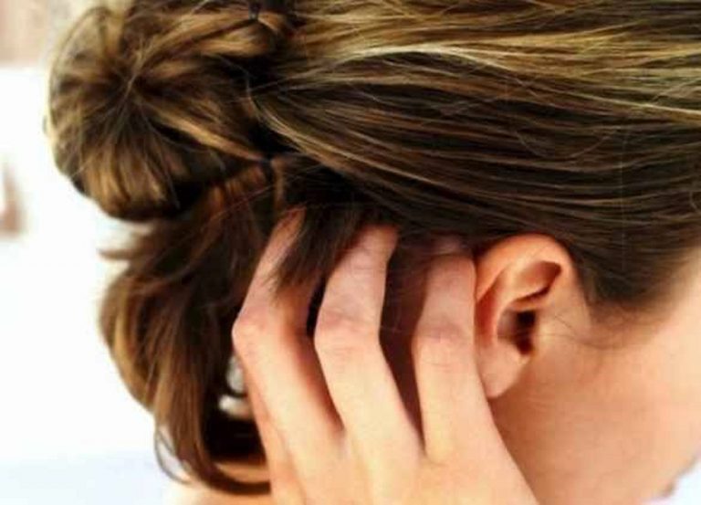 dermatite seborroica: cause e rimedi