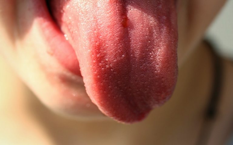 bruciore lingua