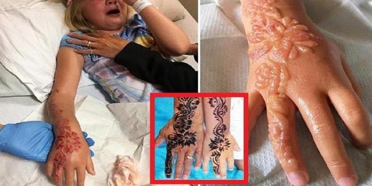 ustionata dal tatuaggio all'henné