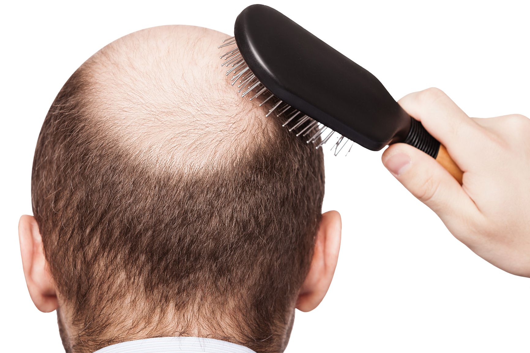 Ricrescita Capelli Uomo Come Curare La Caduta Naturalmente